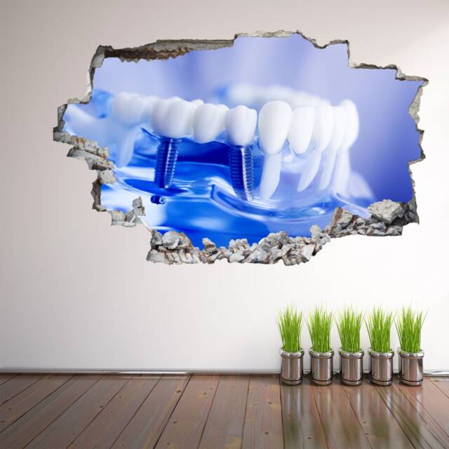 Dental Implant Wall Decal Sticker Mural Poster Print Art Care Decor Ec57